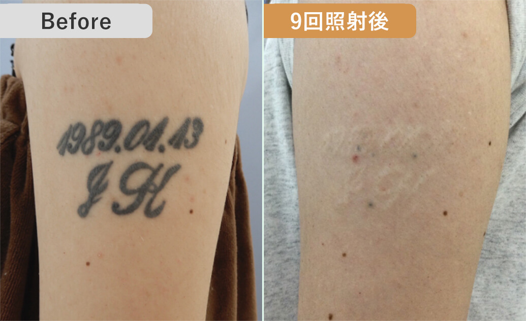 BEFORE/AFTER