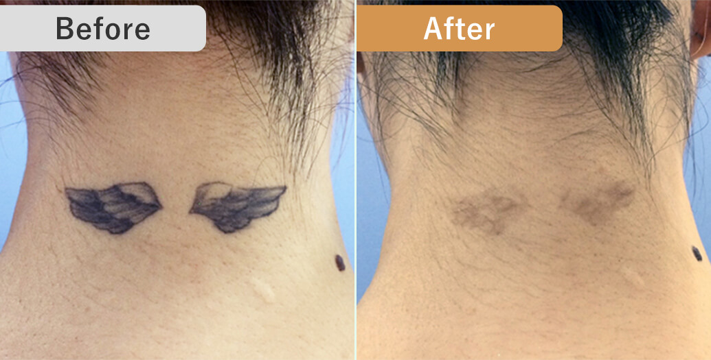 BEFORE/AFTER
