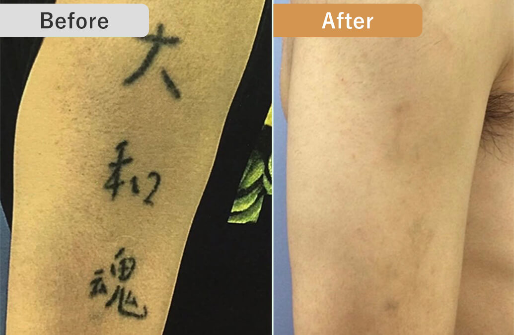 BEFORE/AFTER