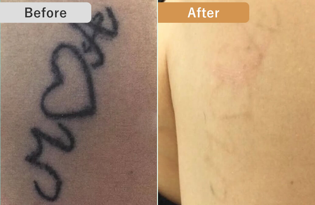 BEFORE/AFTER