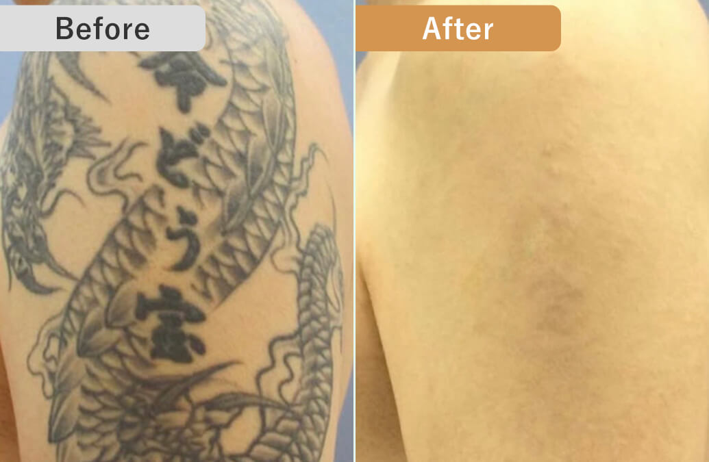 BEFORE/AFTER