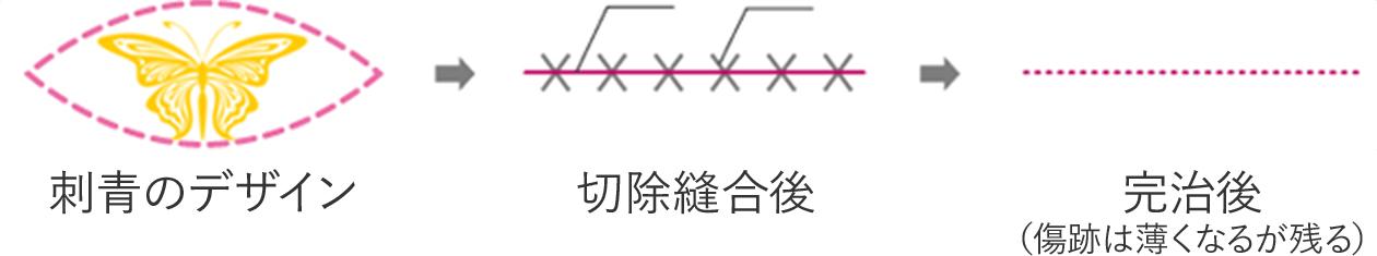 ①単純切除