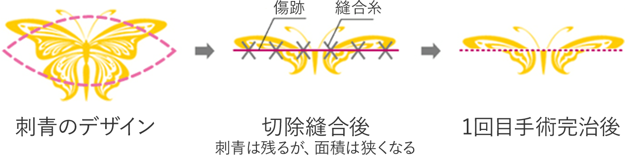 ②分割切除