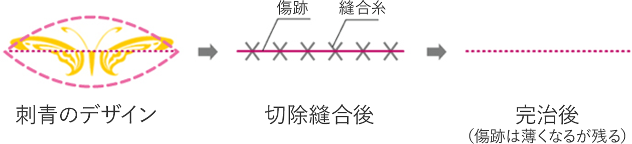 ②分割切除